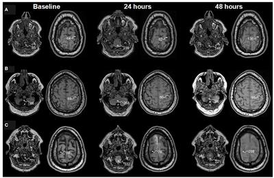 Intrathecal Contrast-Enhanced Magnetic Resonance Imaging of Cerebrospinal Fluid Dynamics and Glymphatic Enhancement in Idiopathic Normal Pressure Hydrocephalus